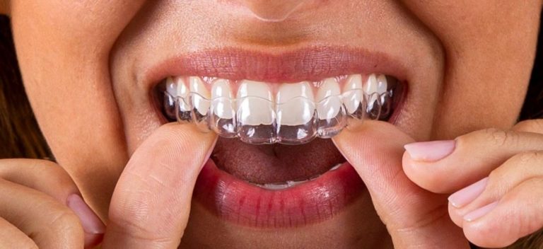 beneficios de la ortodoncia invisible 4 768x352 1